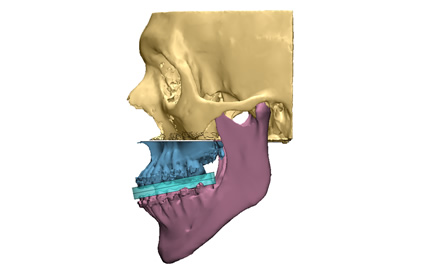 Diagnóstico y Planificación 3D en Argentina Diagnóstico y Planificación 3D en Argentina
