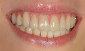 Dientes cariados, fracturados y pigmentados… Dientes cariados, fracturados y pigmentados…