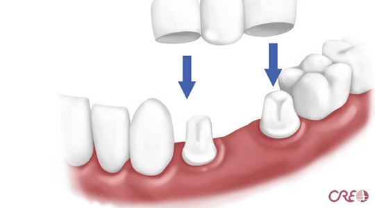 Puentes Dentales - Clinica Creo