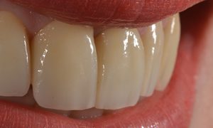 Espacio entre los dientes y malformaciones dentarias Espacio entre los dientes y malformaciones dentarias