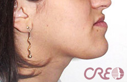 Cirugía Ortognática - Inicial Cirugía Ortognática - Inicial