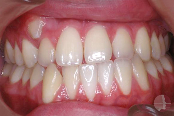 Ortodoncia Lingual - Inicial