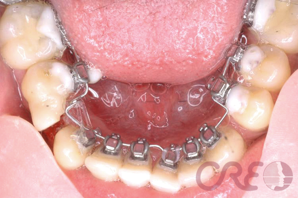Ortodoncia Lingual - Tratamiento
