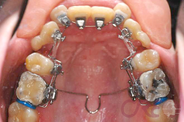 Ortodoncia Lingual - Tratamiento