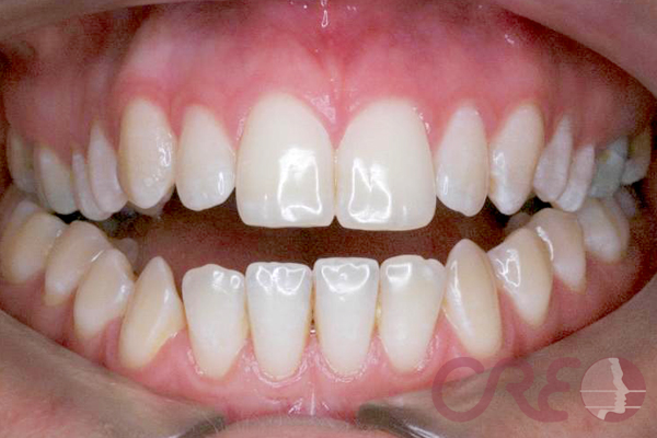 Ortodoncia Lingual - Inicial