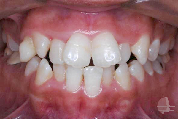 Ortodoncia Lingual - Inicial