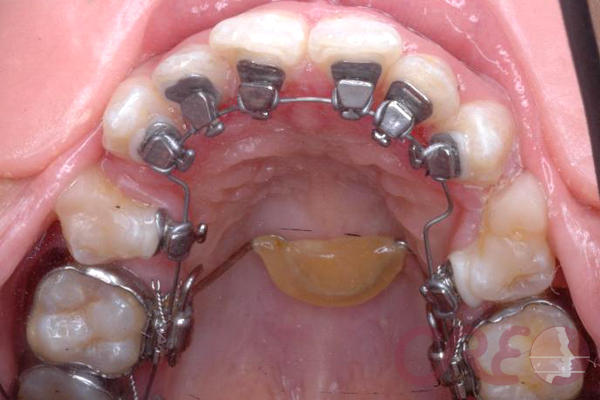Ortodoncia Lingual - Tratamiento