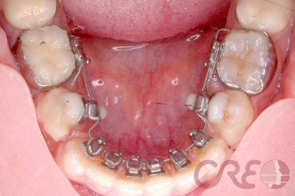 Ortodoncia Lingual - Tratamiento