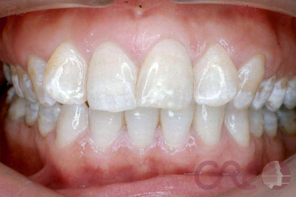Ortodoncia Lingual - Inicial
