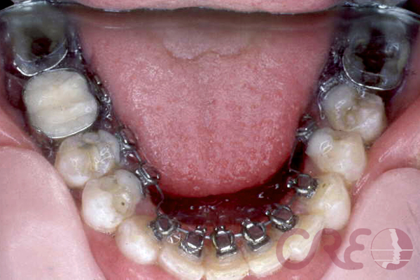 Ortodoncia Lingual - Tratamiento