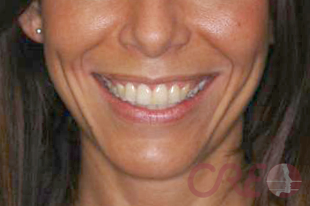 Ortodoncia Lingual - Final