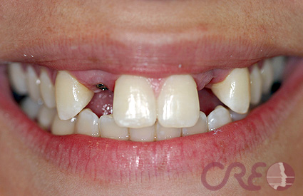 Implantes - Antes Implantes - Antes