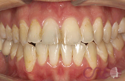Carillas - Antes Carillas - Antes