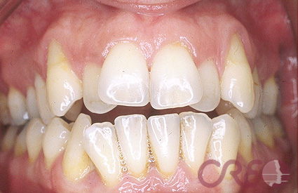 Periodoncia - Antes Periodoncia - Antes