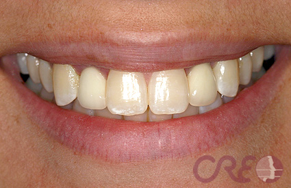 Implantes - Después Implantes - Después