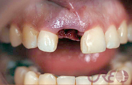 Implantes - Antes Implantes - Antes