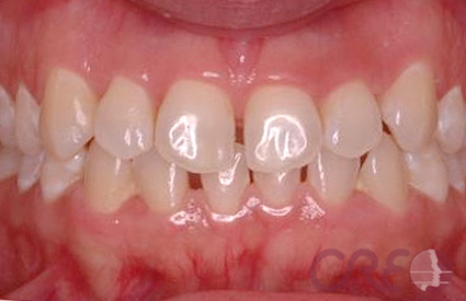 Periodoncia - Antes Periodoncia - Antes