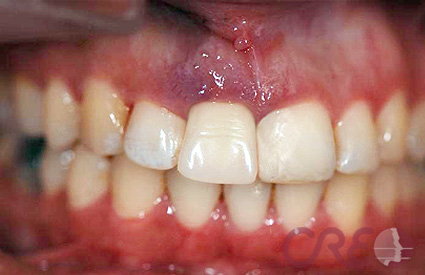 Implantes - Después Implantes - Después