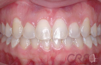 Periodoncia - Después Periodoncia - Después