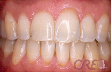 Periodoncia - Antes Periodoncia - Antes