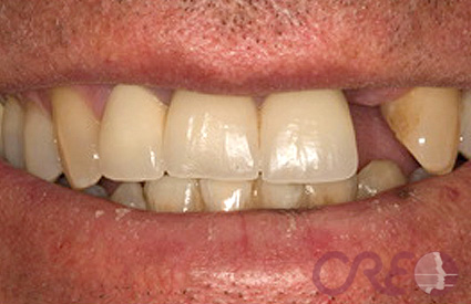 Implantes - Antes Implantes - Antes