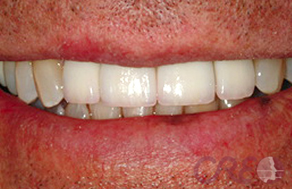 Implantes - Después Implantes - Después