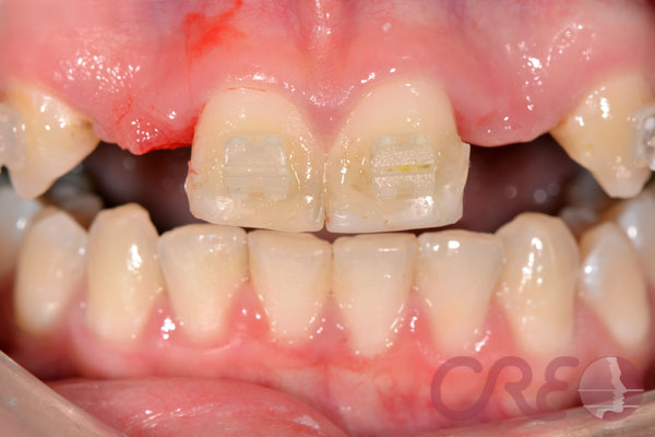 Implantes - Antes