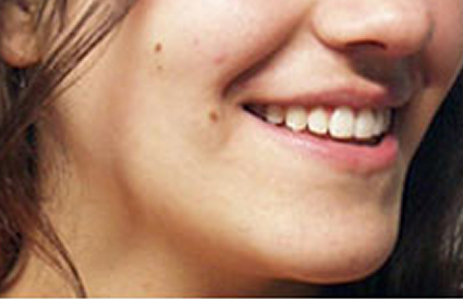 Cirugía Ortognática Cirugía Ortognática