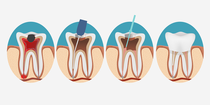 ENDODONCIA (TRATAMIENTO DE CONDUCTOS) ENDODONCIA (TRATAMIENTO DE CONDUCTOS)