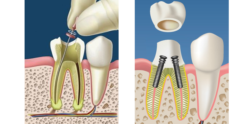 ENDODONCIA (TRATAMIENTO DE CONDUCTOS) ENDODONCIA (TRATAMIENTO DE CONDUCTOS)