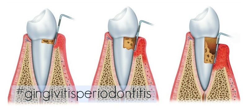 Gingivitis y Periodontitis Gingivitis y Periodontitis