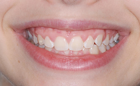 gingivitis-periodontitis4