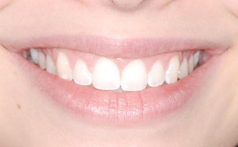 gingivitis-periodontitis5