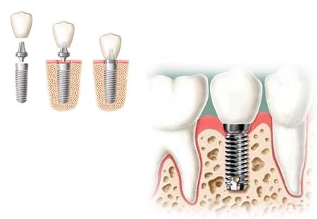 implantes