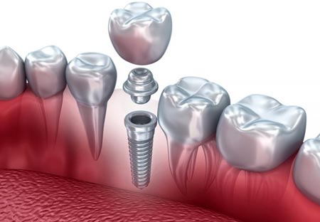 implantes2