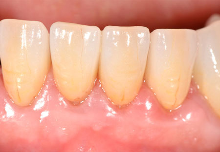 implantes