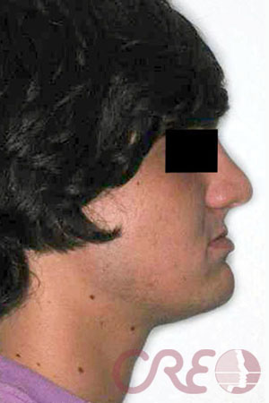 Cirugía Ortognática - Inicial