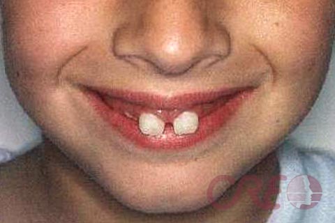 Ortodoncia Niños - Inicial