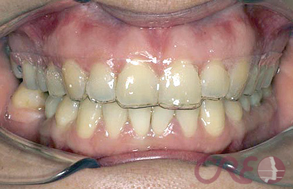 Ortodoncia Invisible - Antes Ortodoncia Invisible - Antes