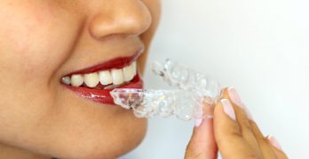 ClearAligner ClearAligner