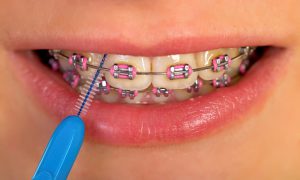 Interdental brushing
