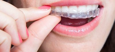 Invisibles - Clear-Aligners Invisibles - Clear-Aligners