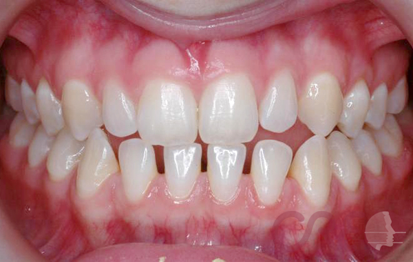 Ortodoncia Lingual - Inicial