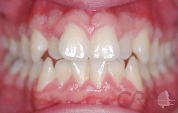 Ortodoncia Lingual - Inicial
