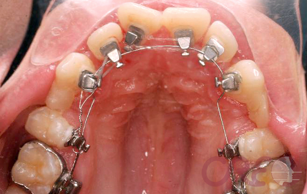Ortodoncia Lingual - Tratamiento