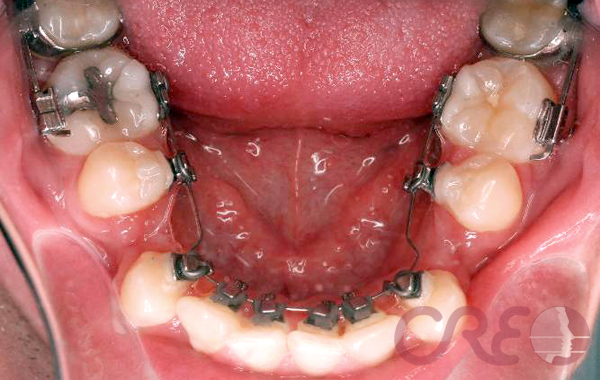 Ortodoncia Lingual - Tratamiento
