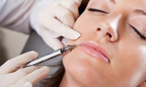Relleno de arrugas arriba y alrededor de los labios. Relleno de arrugas arriba y alrededor de los labios.