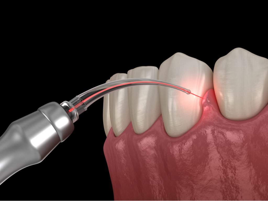 Laser-Gum-Surgery-1024x768-1